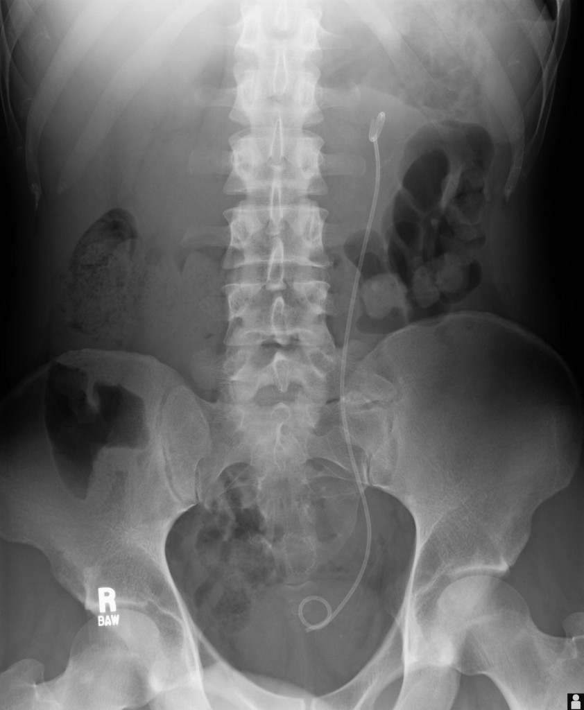 Abdominal_Xray_with_uretal_stent PinkyBone