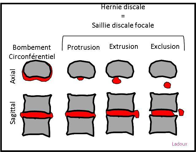 Rachis Lombaire D g n ratif PinkyBone