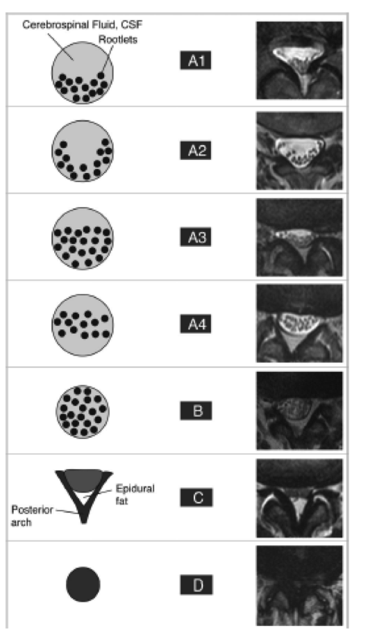 Rachis Lombaire D g n ratif PinkyBone