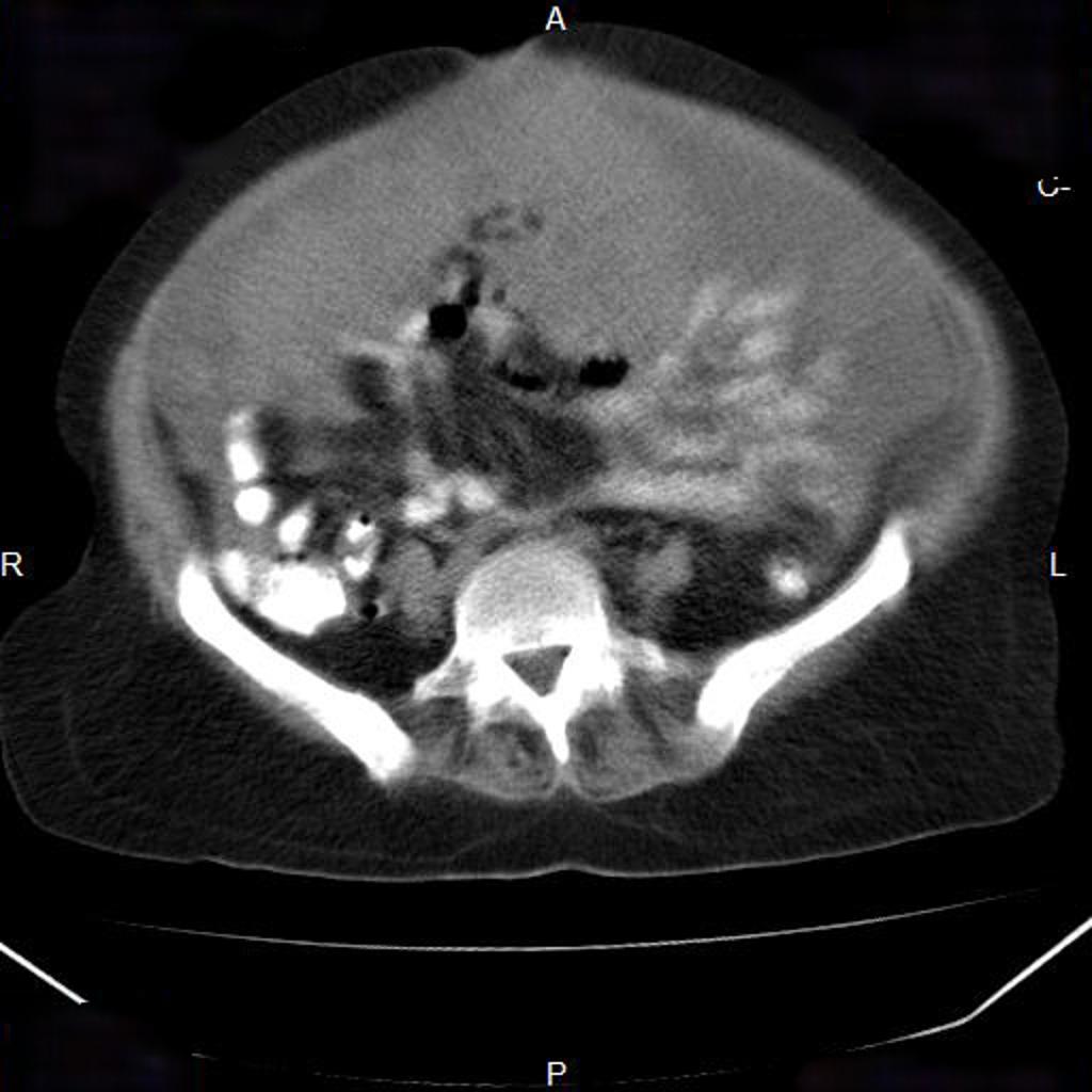 Cancer de l'ovaire avec carcinose péritonéale