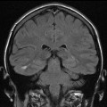 Dysplasie corticale focale temporale droite
