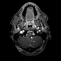 Hémangioblastome dans le cadre d'une maladie de Von Hippel Lindau