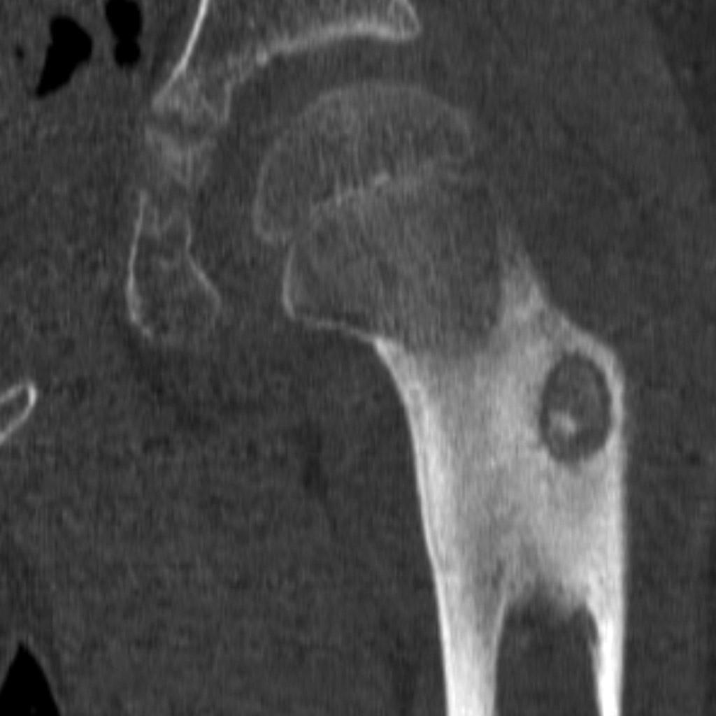 Ostéome ostéoïde