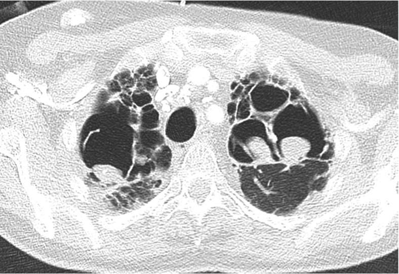 Aspergillomes pulmonaires (têtes aspergillaires arrondies et déclives) dans des cavités pulmonaires séquellaires bi-apicales.
