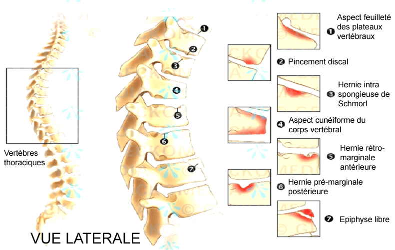 Rachis Maladie De Scheuermann PinkyBone