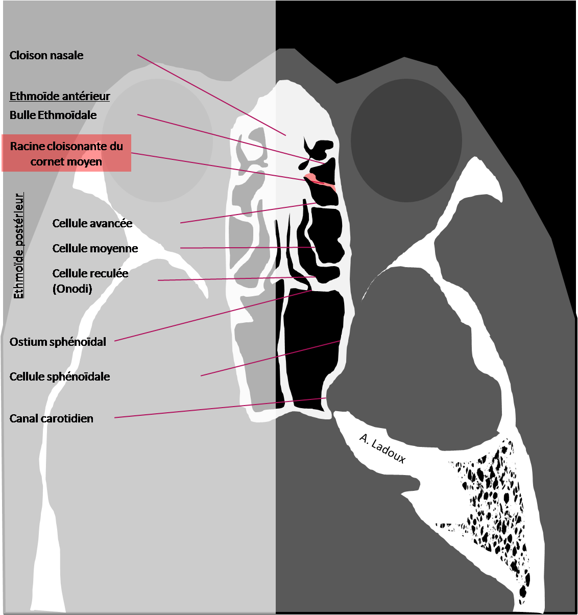 Anatomie axiale des sinus