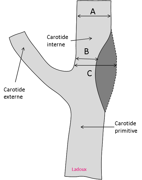 Carotide