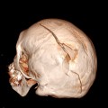 Hématome extra dural