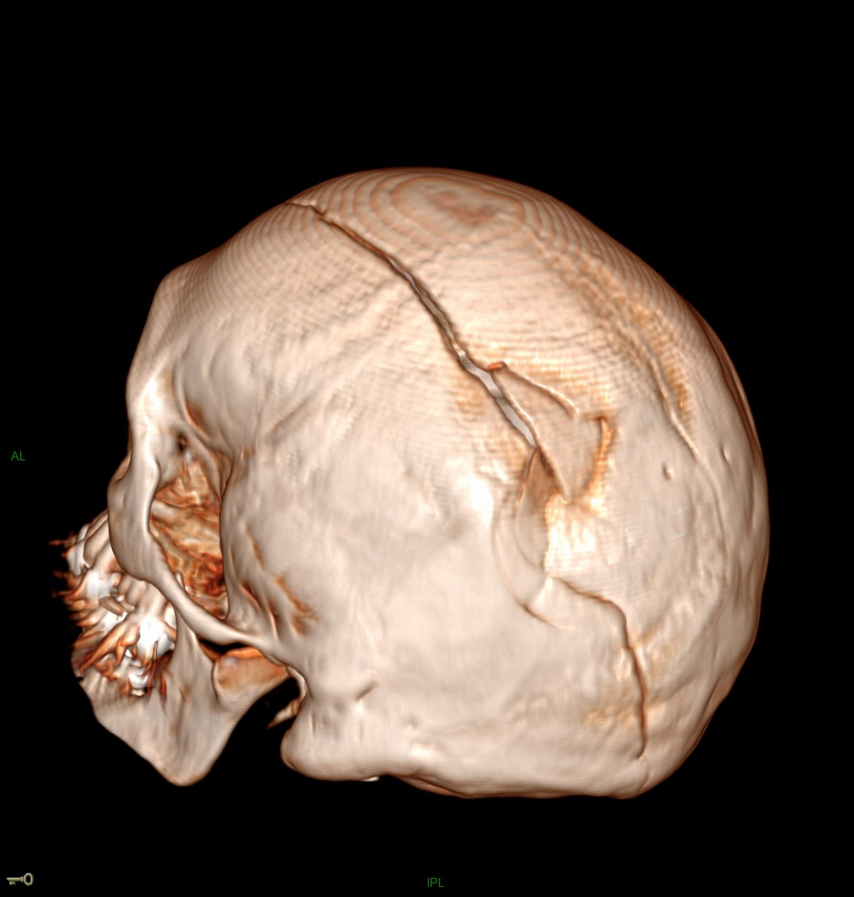 Hématome extra dural