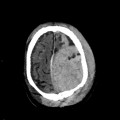 Hématome extra dural