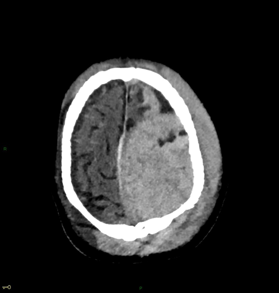 Hématome extra dural