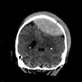 Hématome extra dural