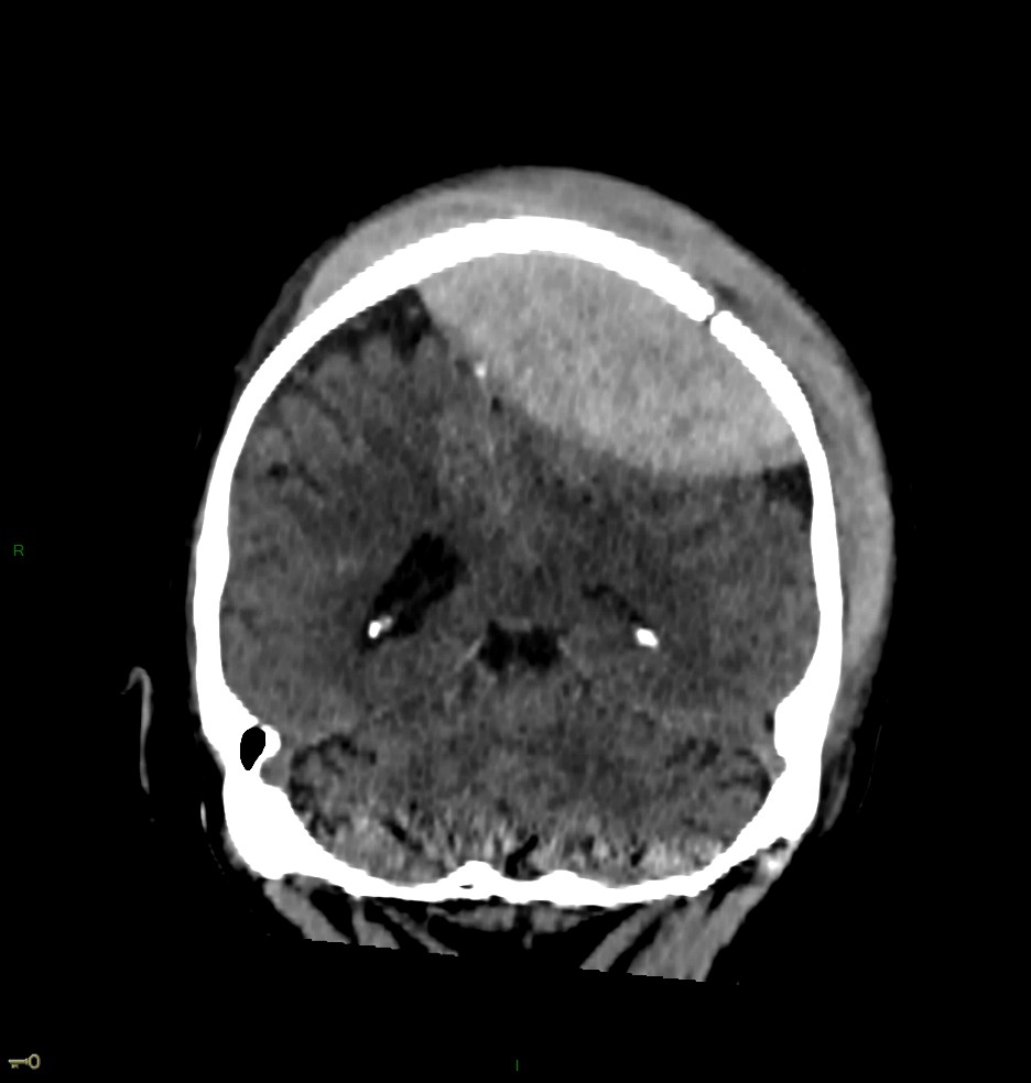 Hématome extra dural