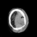 Hématome extra dural