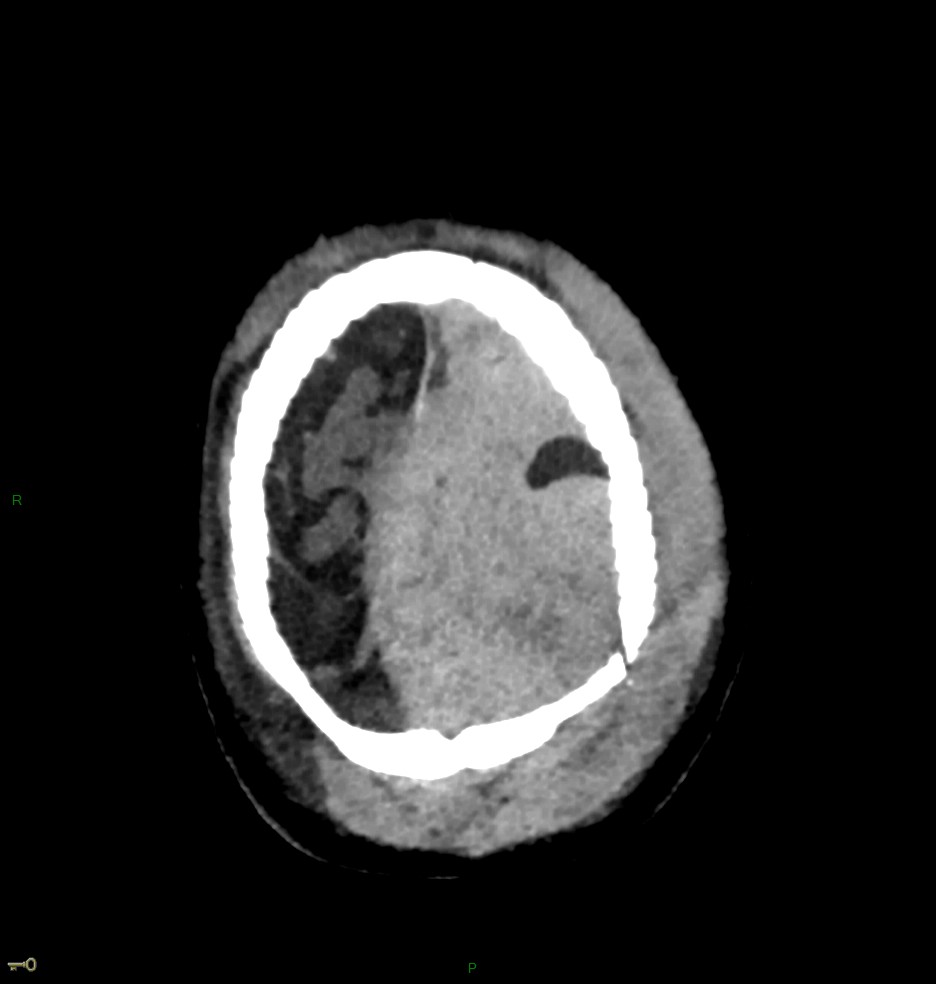 Hématome extra dural