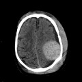 Hématome extra dural