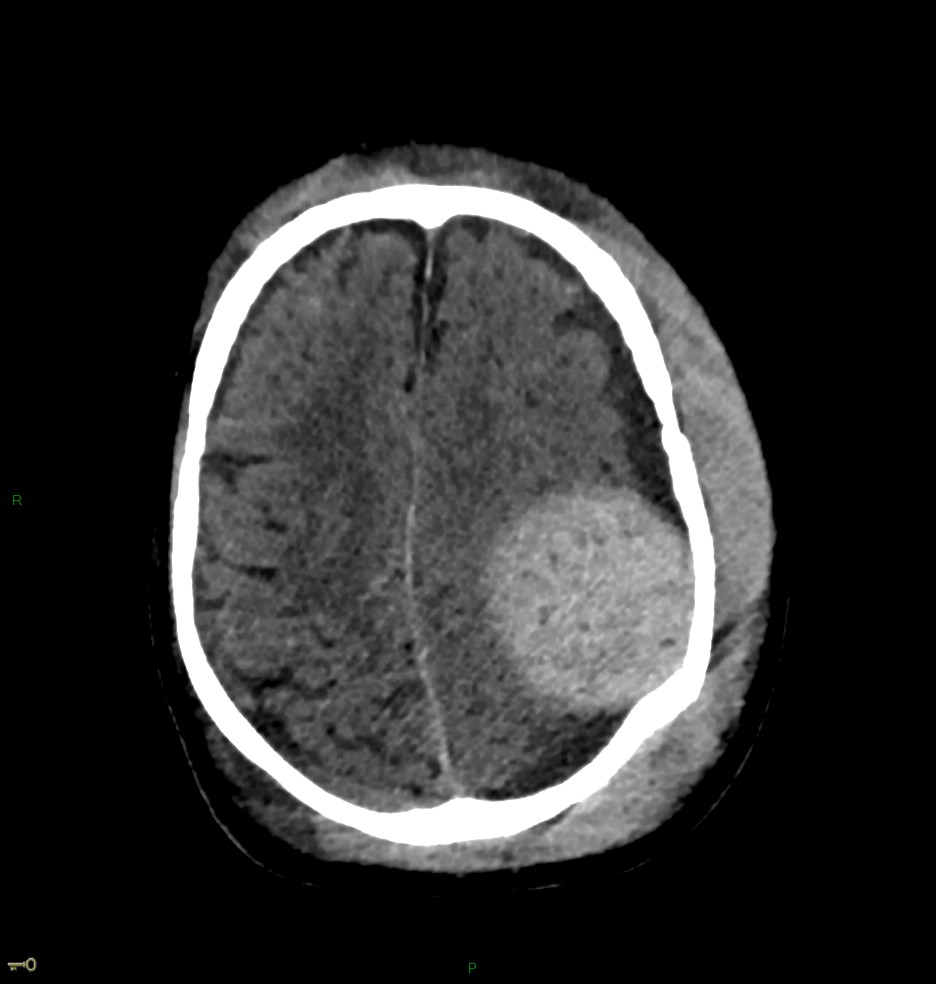 Hématome extra dural