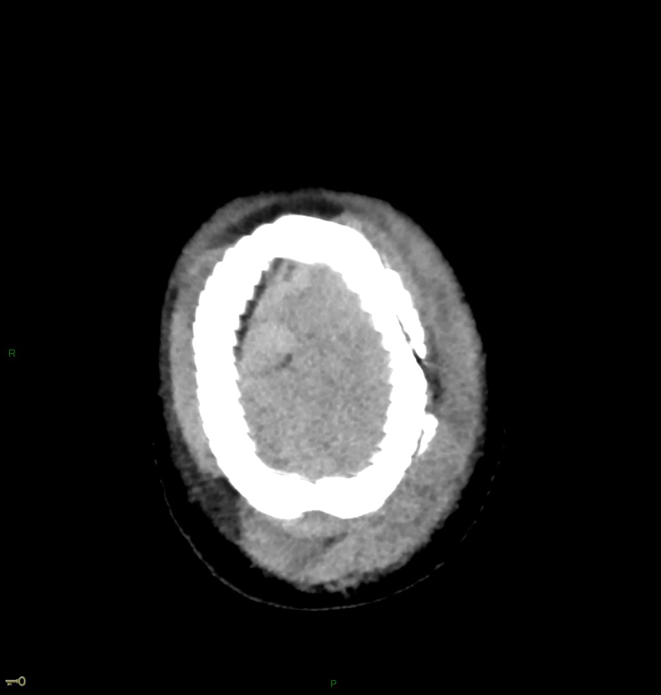 Hématome extra dural