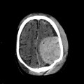 Hématome extra dural