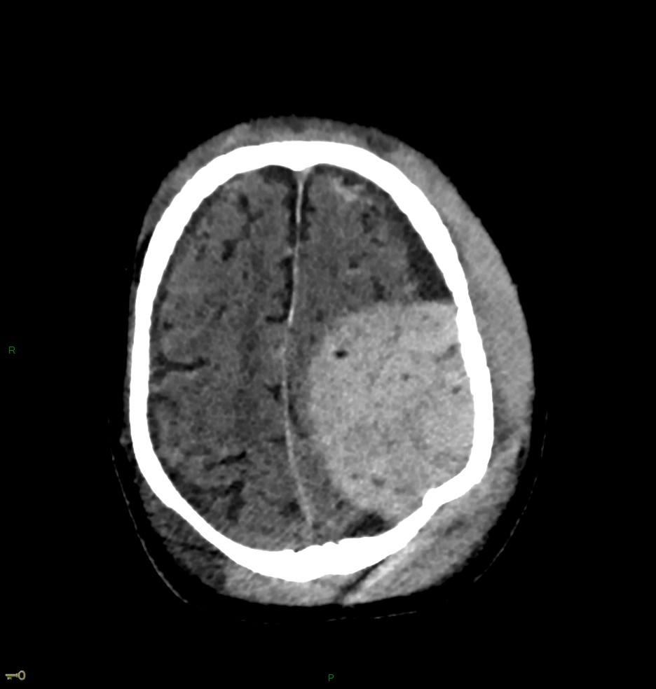 Hématome extra dural