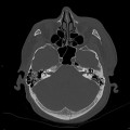 Hématome extra dural