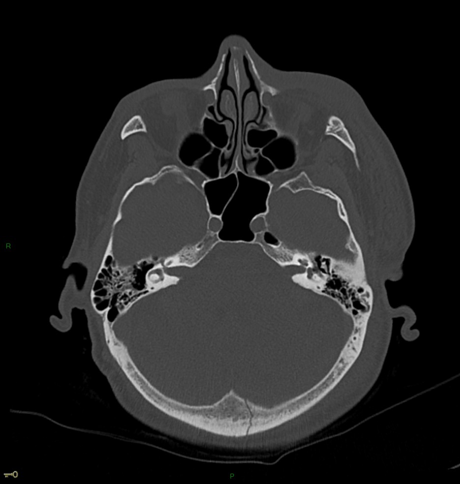 Hématome extra dural