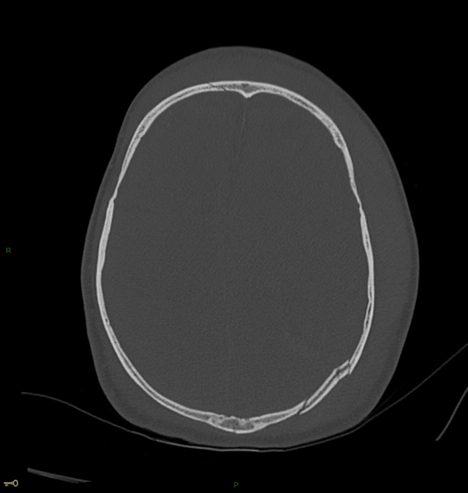 Hématome extra dural