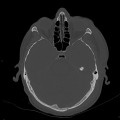 Hématome extra dural