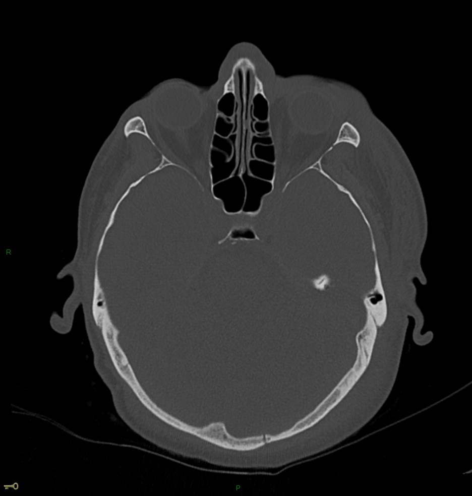 Hématome extra dural