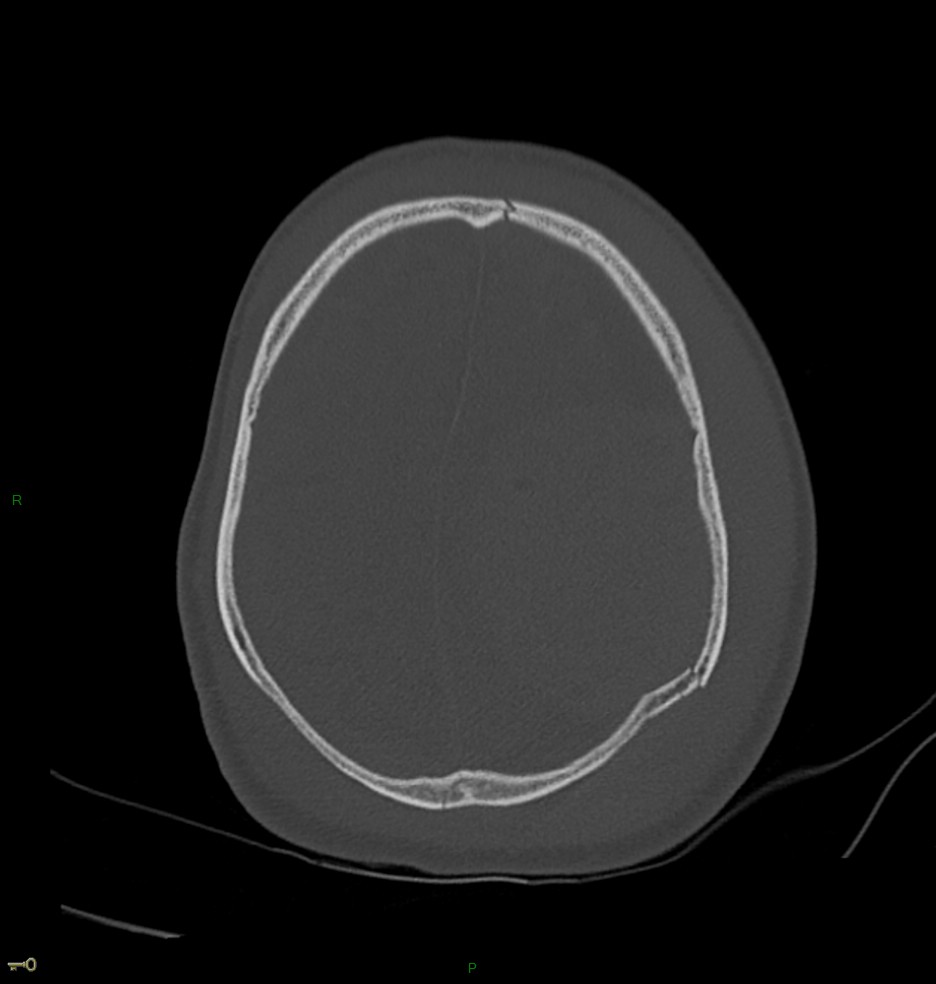 Hématome extra dural