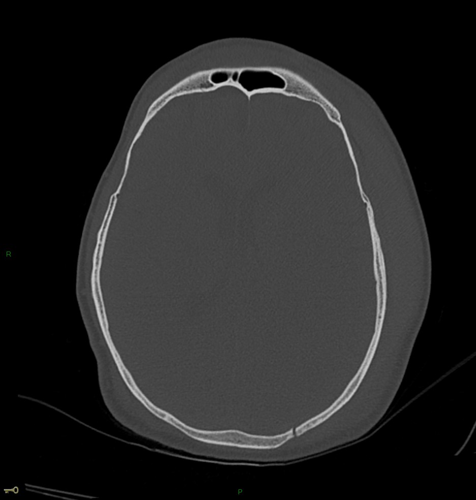 Hématome extra dural