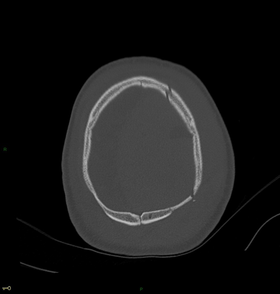 Hématome extra dural