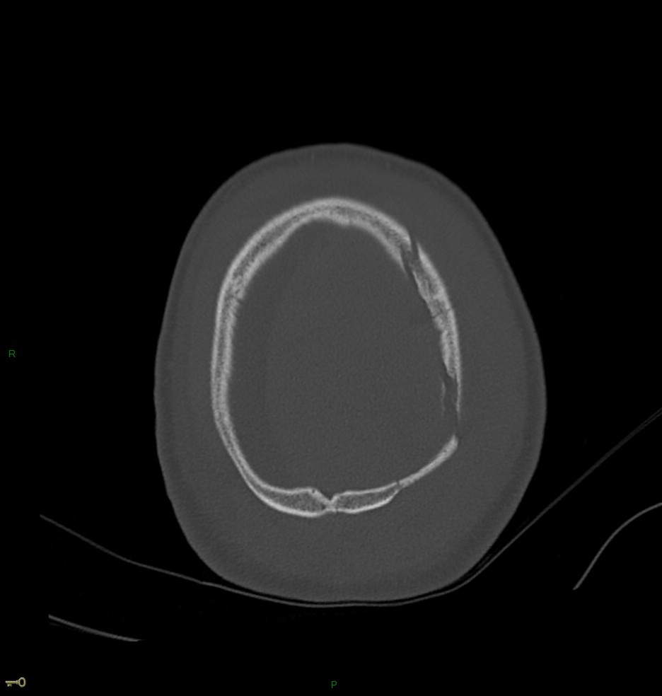 Hématome extra dural