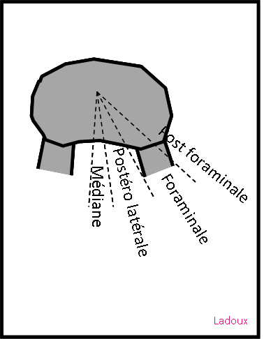 Rachis lombaire – Dégénératif – PinkyBone