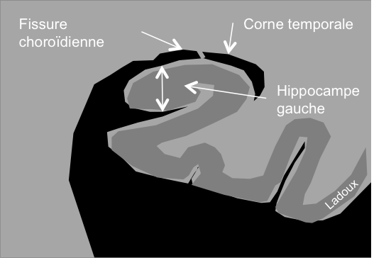 Hippocampe normal de l'hippocampe