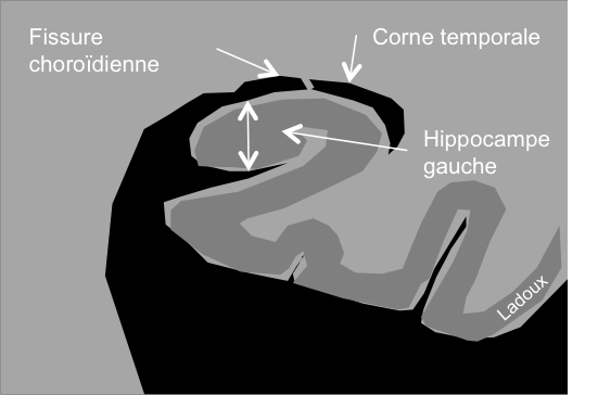 Démence & Imagerie du cerveau âgé PinkyBone