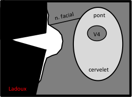 Méningiome