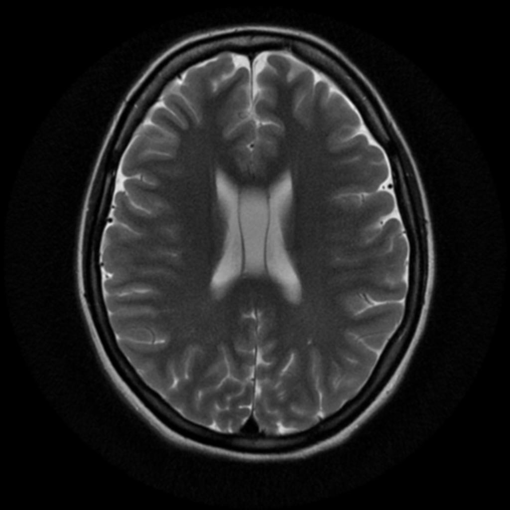 cavum-septum-pellucidum-and-vergae