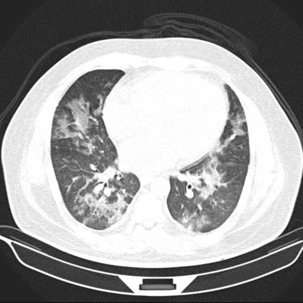 Case courtesy of Dr Mohammad Taghi Niknejad, Radiopaedia.org. From the case rID: 21347