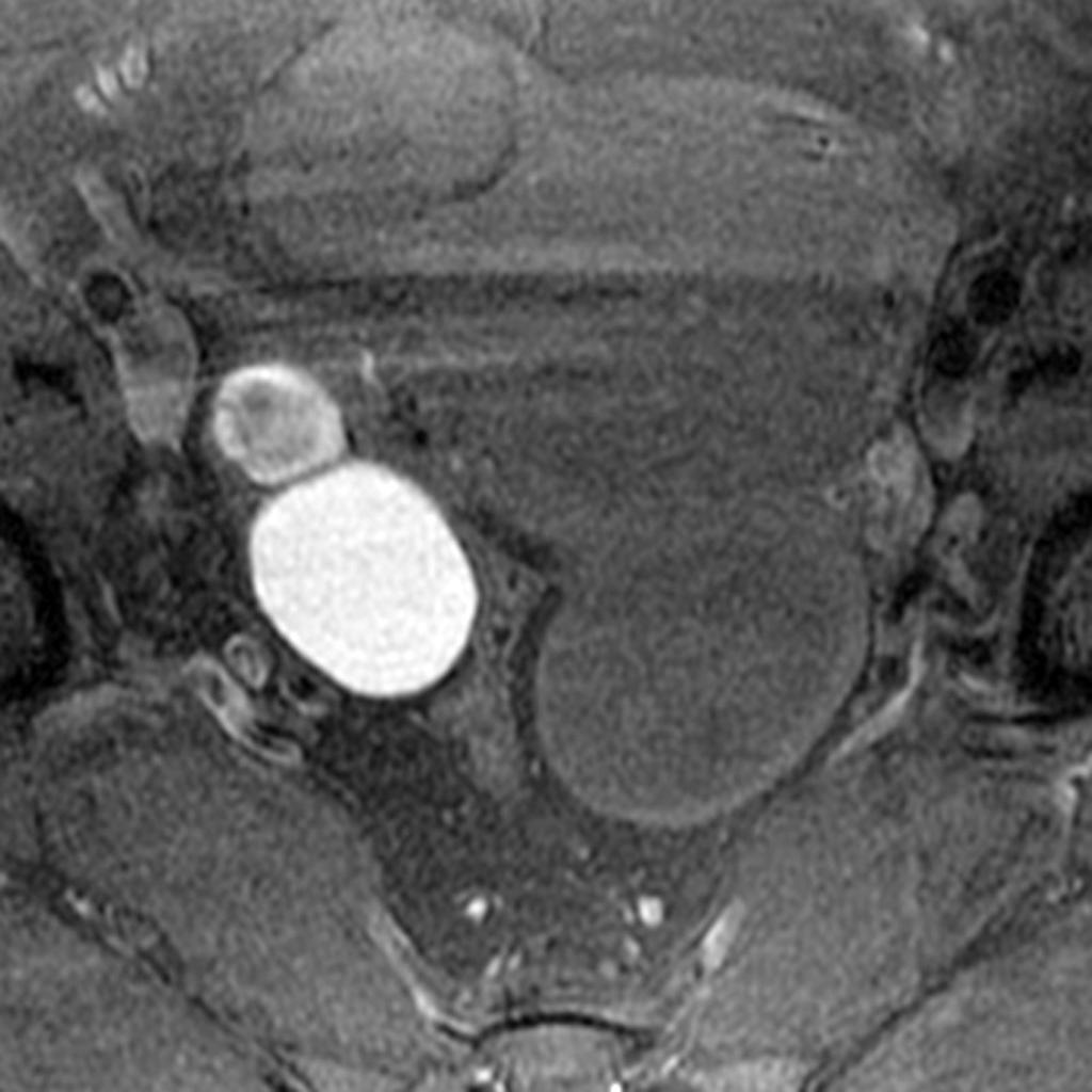 Endométriome