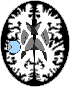 Gangliogliome – Gangliocytome