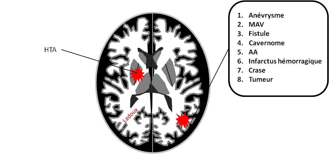 Hématomes cérébraux intra parenchymateux