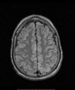 hypoglycemic-brain-injury (12) – PinkyBone