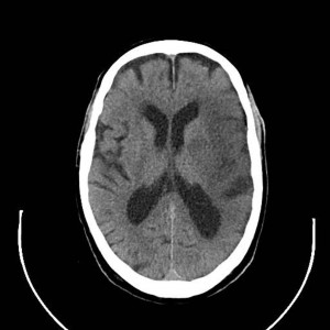 AVC : Effacement des sillons corticaux - Effacement du noyau lenticulaire - Dedifférenciation gris-blanc