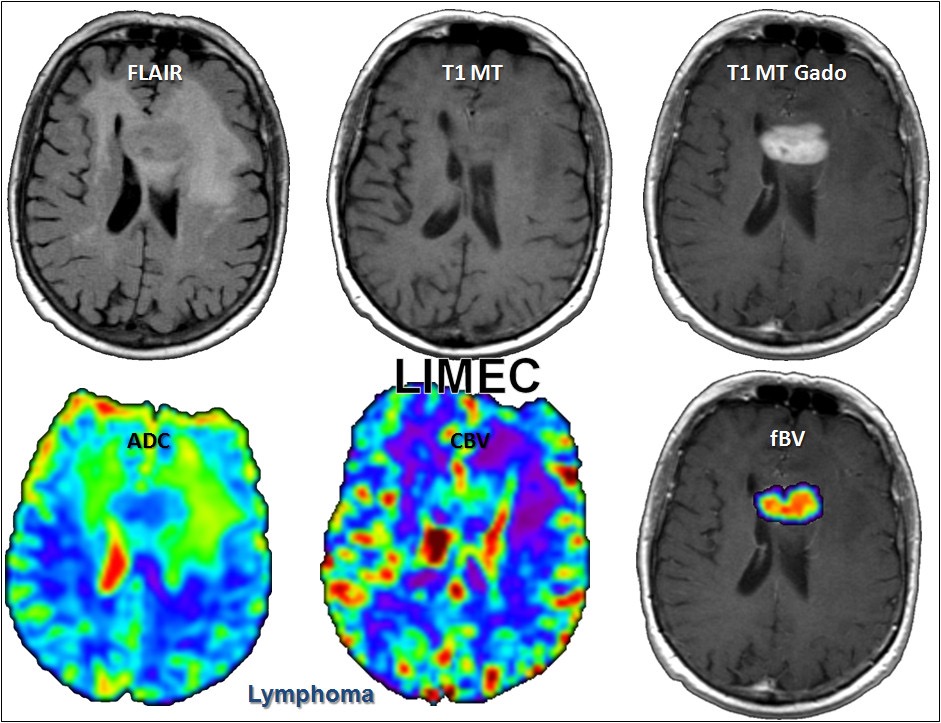 Lymphome cérébral