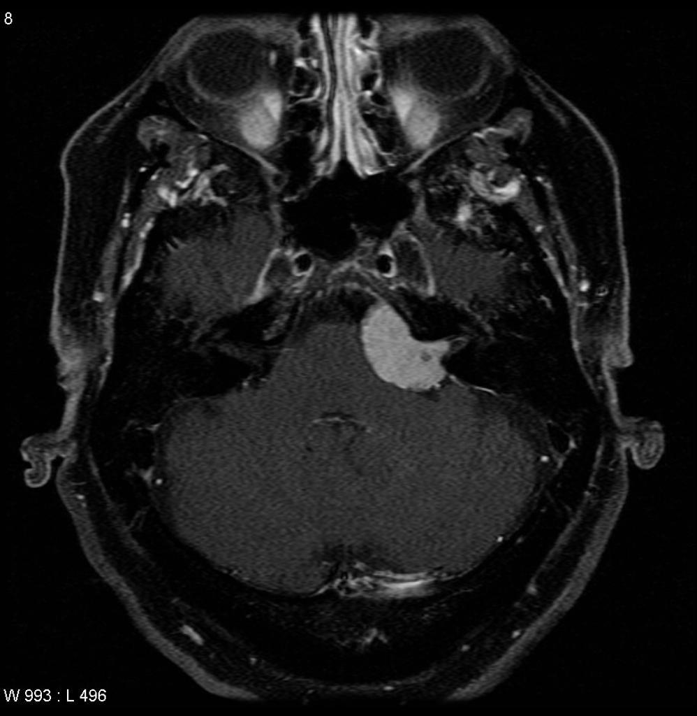 Méningiome de l'angle ponto cérébelleux gauche