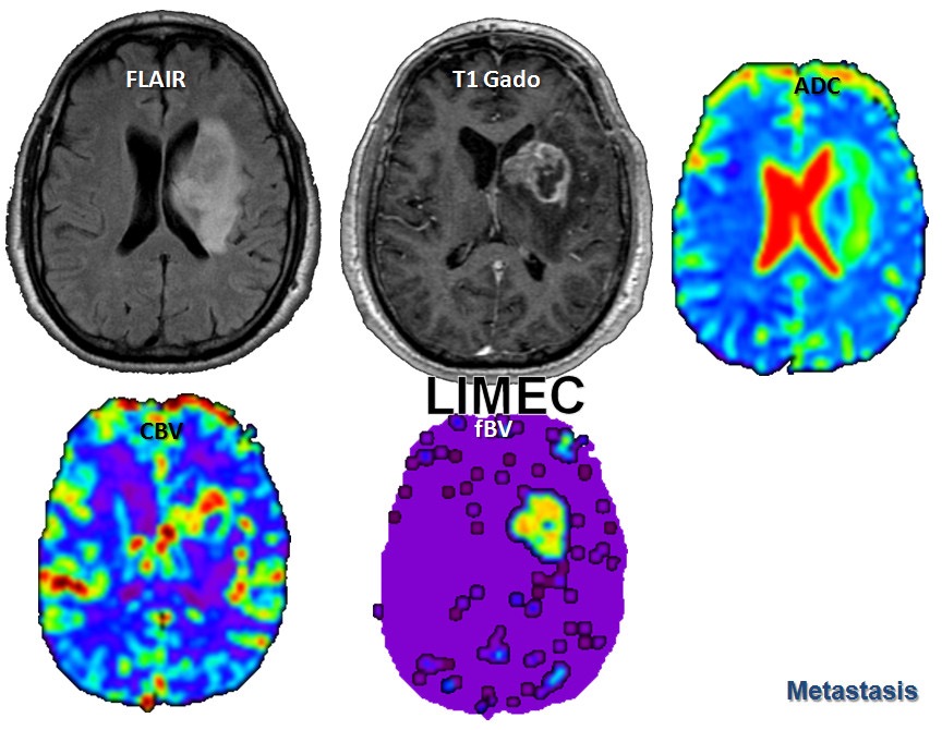 Métastase