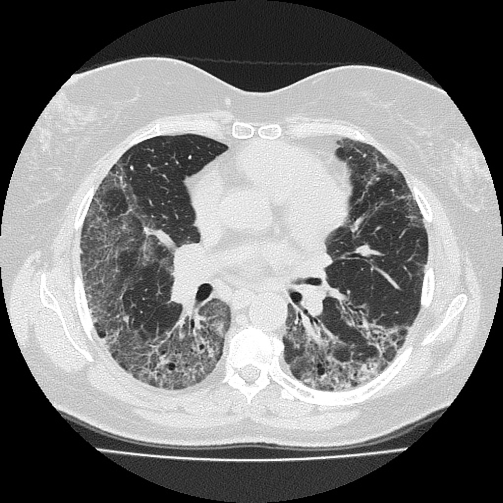 Case courtesy of Rogério Augusto Lima Guarneri, Radiopaedia.org. From the case rID: 31651