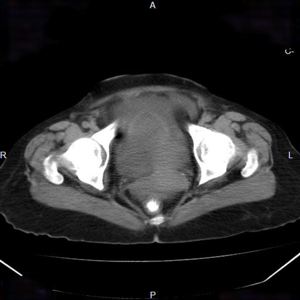 Cancer de l'ovaire avec carcinose péritonéale