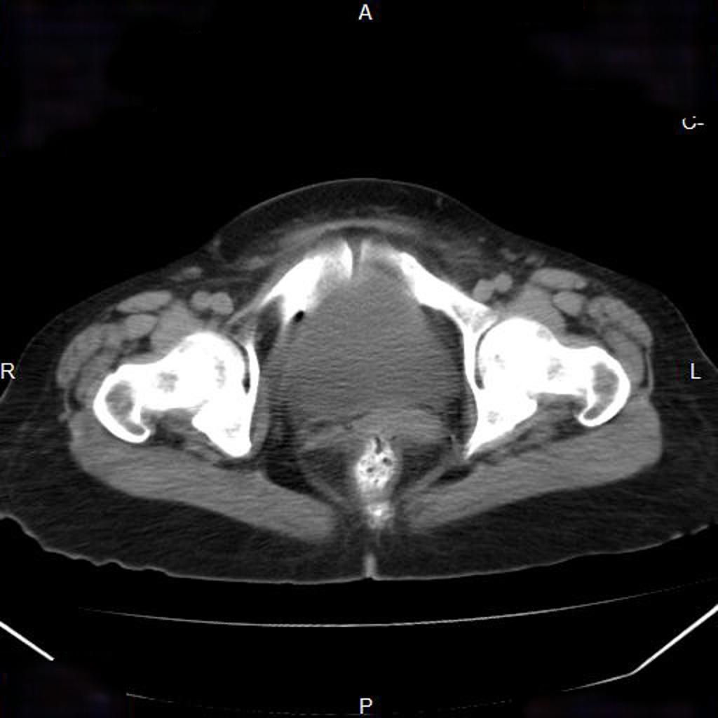 Cancer de l'ovaire avec carcinose péritonéale